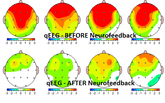 Neurofeedback-QEEG